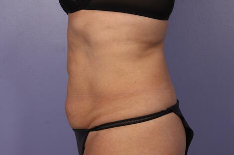 CoolSculpting Gallery Before & After Image