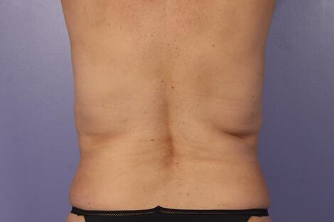 CoolSculpting Gallery Before & After Image