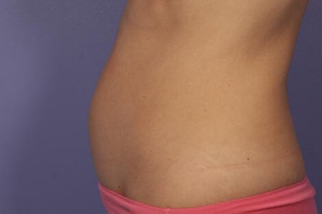 CoolSculpting Gallery Before & After Image