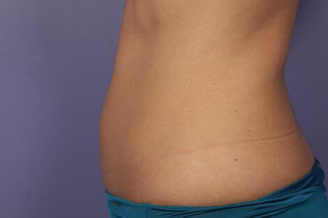 CoolSculpting Gallery Before & After Image