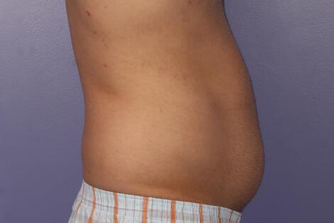 CoolSculpting Gallery Before & After Image