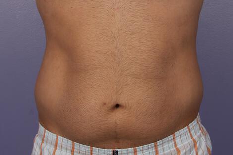 CoolSculpting Gallery Before & After Image