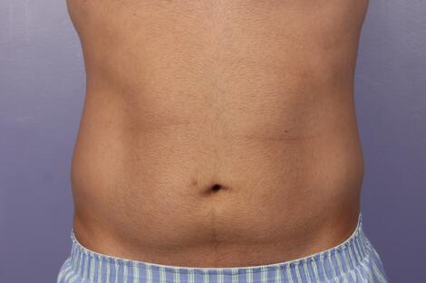 CoolSculpting Gallery Before & After Image