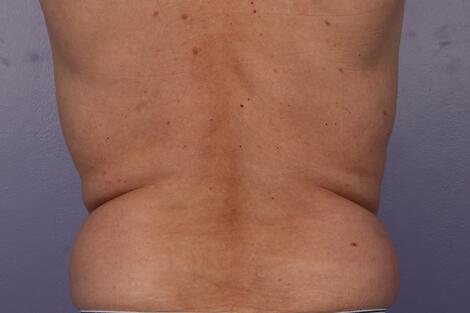 CoolSculpting Gallery Before & After Image