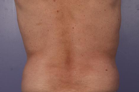 CoolSculpting Gallery Before & After Image