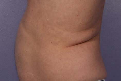 CoolSculpting Gallery Before & After Image