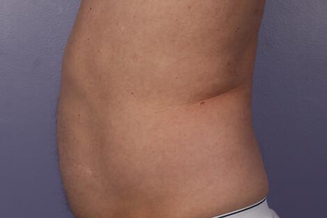 CoolSculpting Gallery Before & After Image