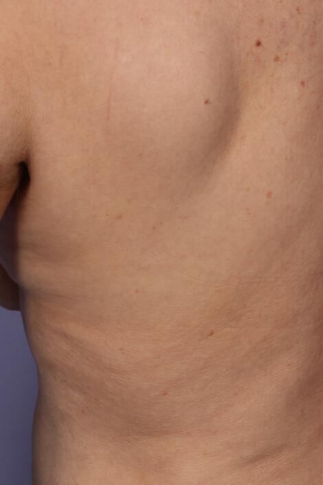 CoolSculpting Gallery Before & After Image