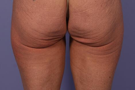 CoolSculpting Gallery Before & After Image