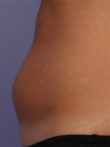 CoolSculpting Gallery Before & After Image