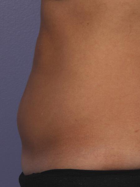 CoolSculpting Gallery Before & After Image