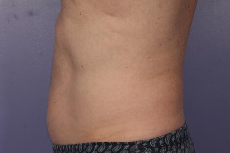 CoolSculpting Gallery Before & After Image