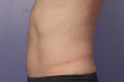 CoolSculpting Gallery Before & After Image