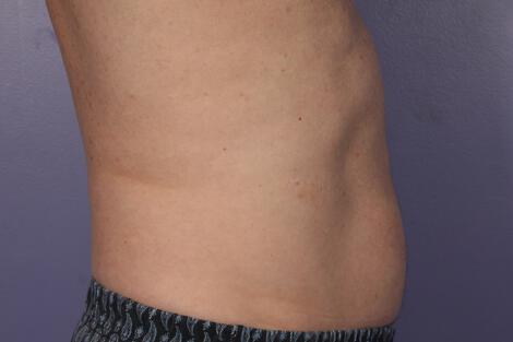 CoolSculpting Gallery Before & After Image