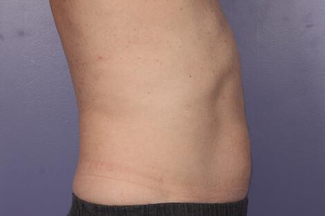 CoolSculpting Gallery Before & After Image