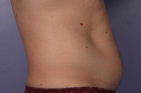 CoolSculpting Gallery Before & After Image