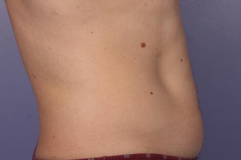 CoolSculpting Gallery Before & After Image