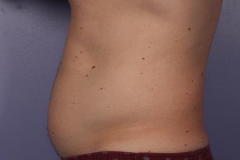 CoolSculpting Gallery Before & After Image