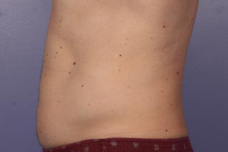 CoolSculpting Gallery Before & After Image