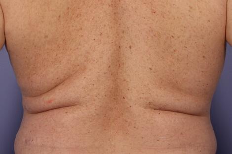 CoolSculpting Gallery Before & After Image