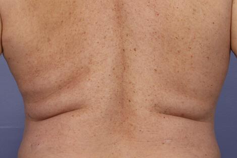 CoolSculpting Gallery Before & After Image