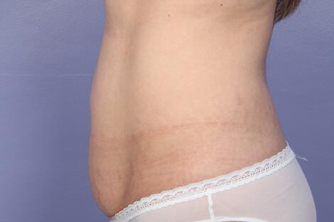 CoolSculpting Gallery Before & After Image