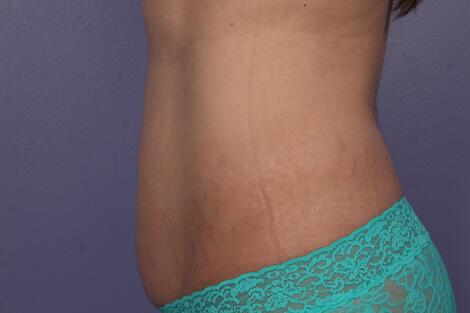 CoolSculpting Gallery Before & After Image