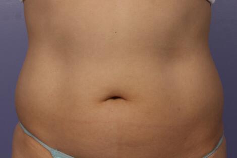 CoolSculpting Gallery Before & After Image