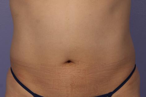 CoolSculpting Gallery Before & After Image