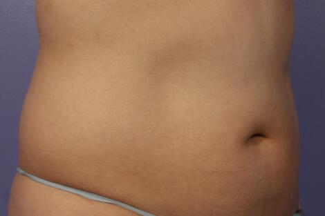 CoolSculpting Gallery Before & After Image