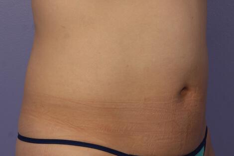 CoolSculpting Gallery Before & After Image