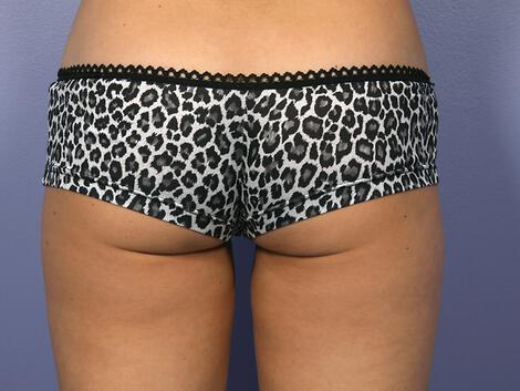 CoolSculpting Gallery Before & After Image