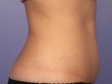 CoolSculpting Gallery Before & After Image