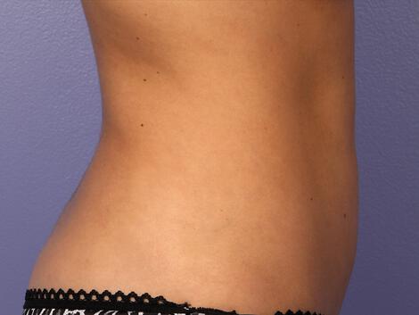 CoolSculpting Gallery Before & After Image