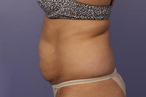 CoolSculpting Gallery Before & After Image