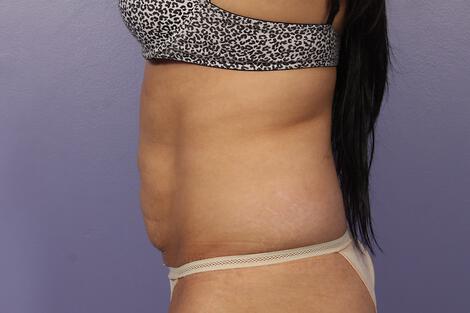 CoolSculpting Gallery Before & After Image