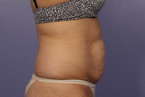 CoolSculpting Gallery Before & After Image