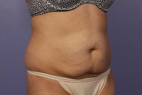 CoolSculpting Gallery Before & After Image