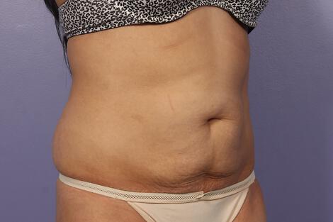 CoolSculpting Gallery Before & After Image