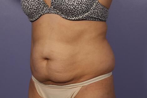 CoolSculpting Gallery Before & After Image