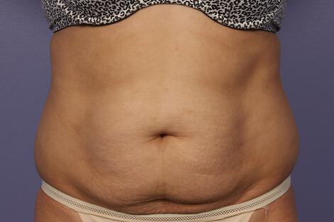 CoolSculpting Gallery Before & After Image