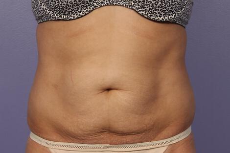 CoolSculpting Gallery Before & After Image