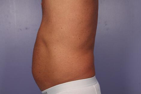 CoolSculpting Gallery Before & After Image