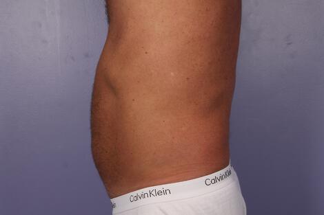 CoolSculpting Gallery Before & After Image