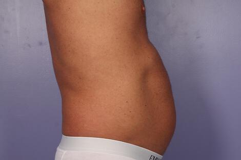 CoolSculpting Gallery Before & After Image