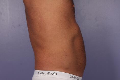 CoolSculpting Gallery Before & After Image