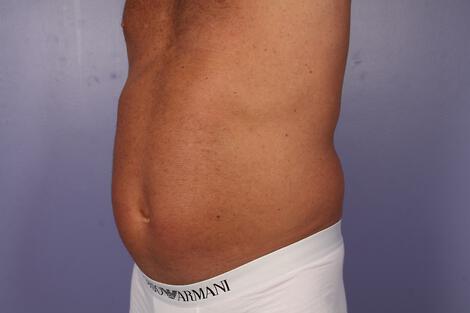 CoolSculpting Gallery Before & After Image