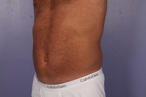 CoolSculpting Gallery Before & After Image