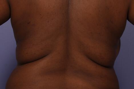 CoolSculpting Gallery Before & After Image