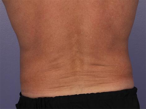 CoolSculpting Gallery Before & After Image